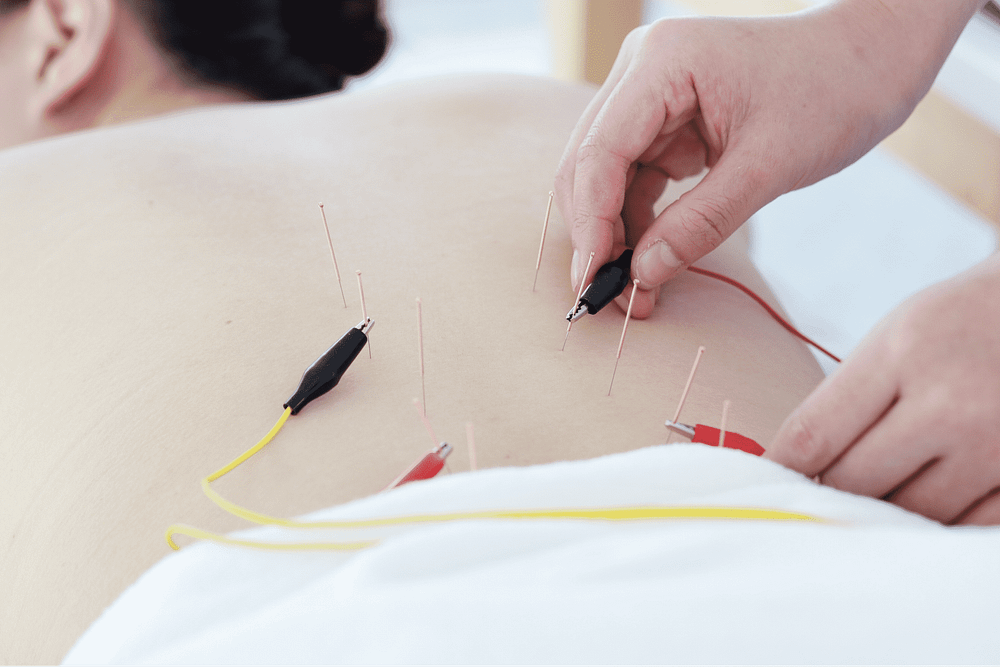 hand-doctor-performing-acupuncture-therapy-asian-female-undergoing-acupuncture-treatment-with-line-fine-needles-inserted-into-her-body-skin-clinic-hospital (1)