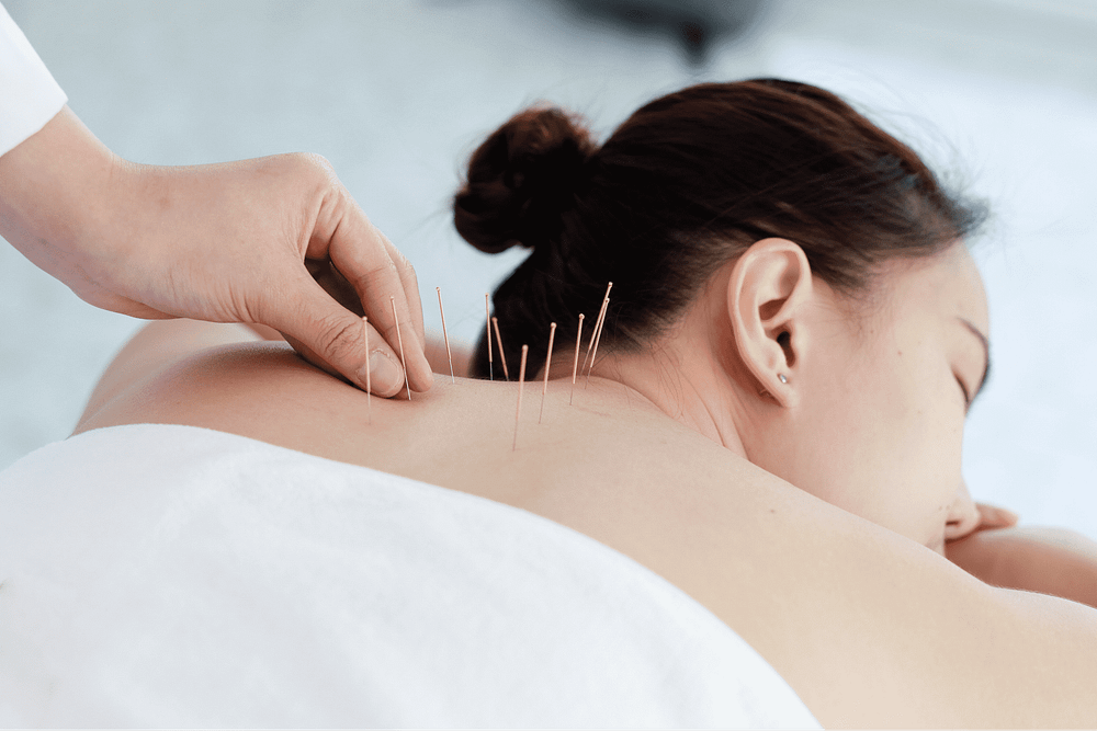 hand-doctor-performing-acupuncture-therapy-asian-female-undergoing-acupuncture-treatment-with-line-fine-needles-inserted-into-her-body-skin-clinic-hospital