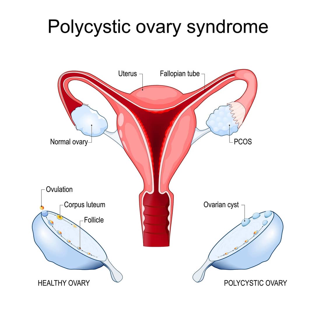 Read more about the article Polycystic ovary syndrome (PCOS)