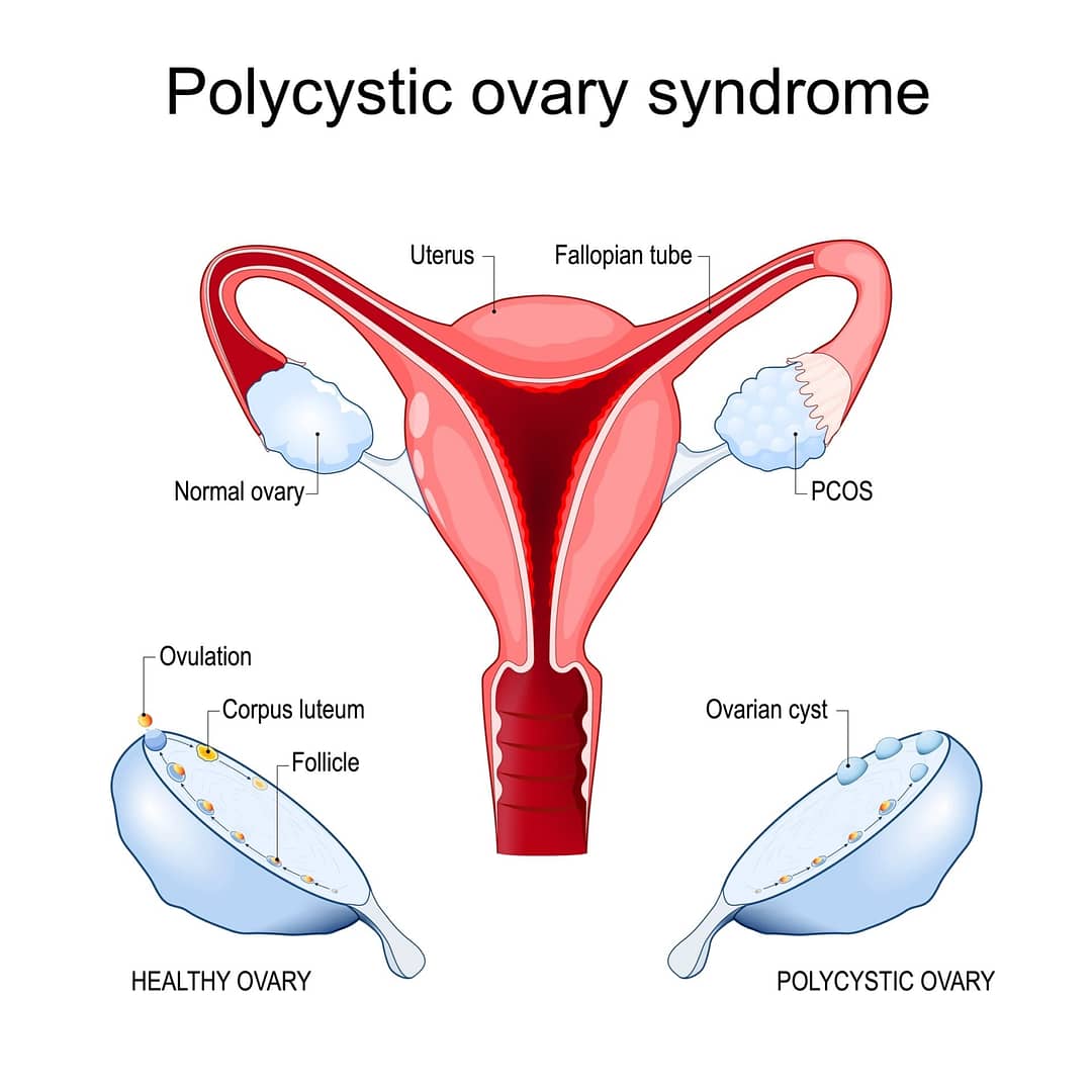 You are currently viewing Polycystic ovary syndrome (PCOS)