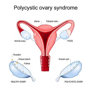 Read more about the article How Traditional Chinese Medicine (TCM) Can Manage PCOS