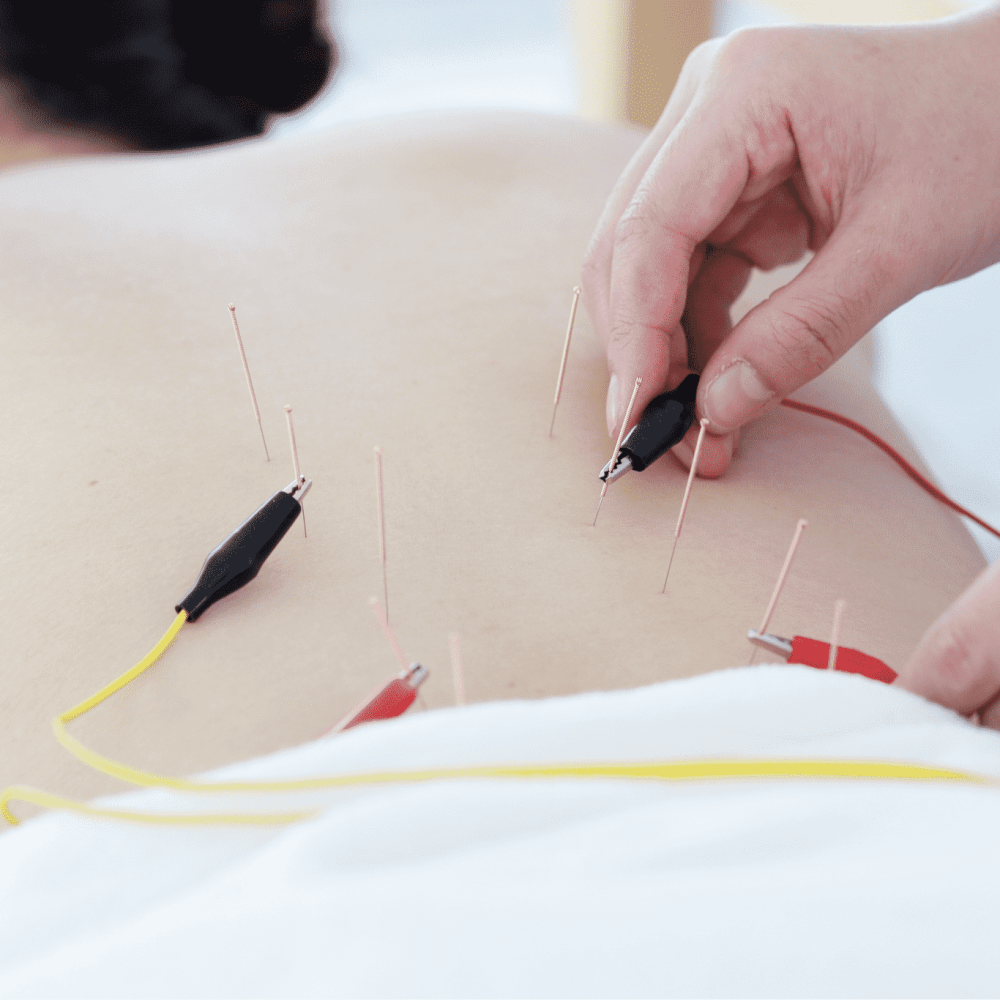 hand-doctor-performing-acupuncture-therapy-asian-female-undergoing-acupuncture-treatment-with-line-fine-needles-inserted-into-her-body-skin-clinic-hospital (1)