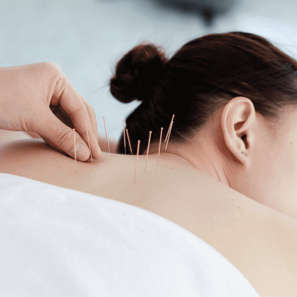 hand-doctor-performing-acupuncture-therapy-asian-female-undergoing-acupuncture-treatment-with-line-fine-needles-inserted-into-her-body-skin-clinic-hospital