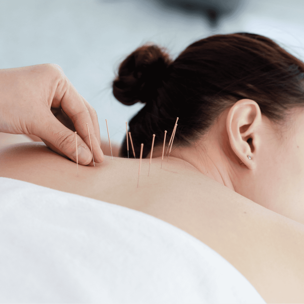 hand-doctor-performing-acupuncture-therapy-asian-female-undergoing-acupuncture-treatment-with-line-fine-needles-inserted-into-her-body-skin-clinic-hospital hand-doctor-performing-acupuncture-therapy-asian-female-undergoing-acupuncture-treatment-with-line-fine-needles-inserted-into-her-body-skin-clinic-hospital